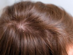 7 Rahasia Ampuh Atasi Jamur di Kepala Pakai Bahan dari Rumah