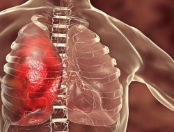 Klasifikasi Pneumonia: Mengetahui Jenis dan Cara Penyebarannya Klasifikasi Pneumonia: Mengetahui Jenis dan Cara Penyebarannya