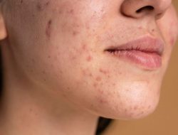 Skin Barrier Rusak? Ini 9 Langkah Efektif untuk Memulihkan Kesehatan Kulit Anda