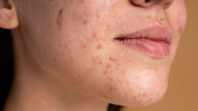 Skin Barrier Rusak? Ini 9 Langkah Efektif untuk Memulihkan Kesehatan Kulit Anda