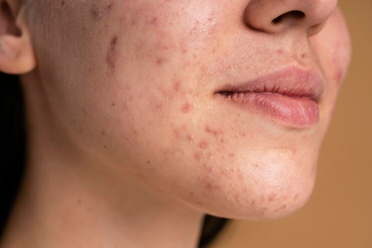 Skin Barrier Rusak? Ini 9 Langkah Efektif untuk Memulihkan Kesehatan Kulit Anda