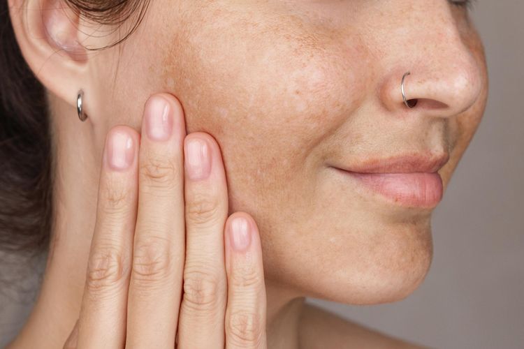 Cara Cerdas Atasi Noda Hitam untuk Kulit yang Lebih Cerah dan Seragam