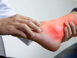 Kenali Gejala Awal Asam Urat pada Kaki Sebelum Terlambat
