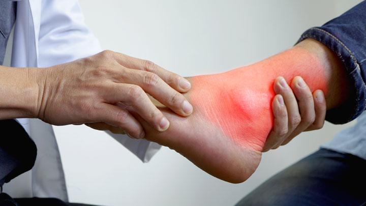 Kenali Gejala Awal Asam Urat pada Kaki Sebelum Terlambat