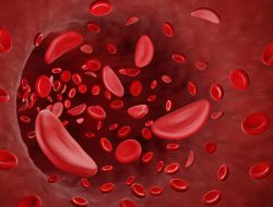Kwara: Over 10,000 Residents Screened for Sickle Cell in Five Years Kwara: Over 10,000 Residents Screened for Sickle Cell in Five Years