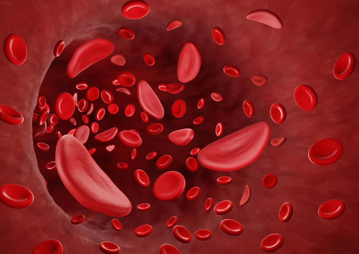 Kwara: Over 10,000 Residents Screened for Sickle Cell in Five Years