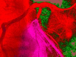 How a Hidden Heart Blockage Was Detected: A Patient’s Symptom-Free Journey