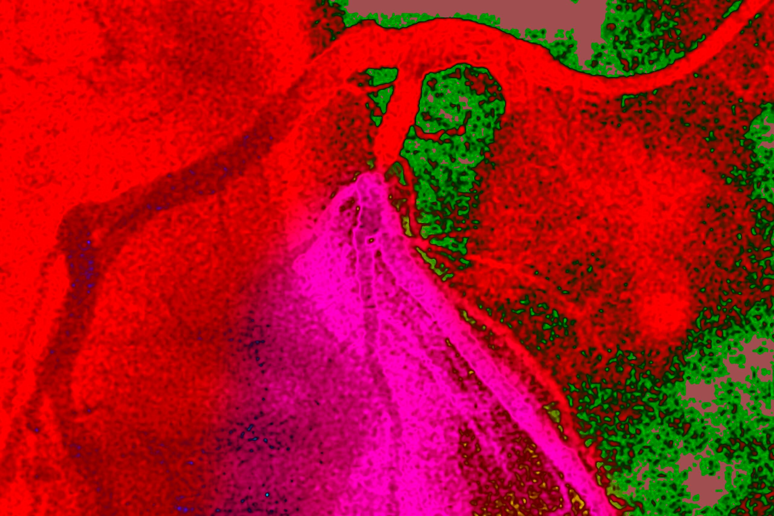 How a Hidden Heart Blockage Was Detected: A Patient’s Symptom-Free Journey