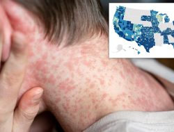 Scary Map Forecasts Surge of World’s Most Contagious Disease in These U.S. Counties – International Edition (English) Scary Map Forecasts Surge of World’s Most Contagious Disease in These U.S. Counties – International Edition (English)