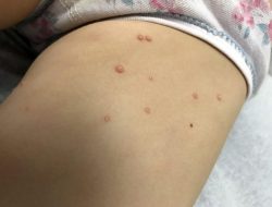 7 Alasan Munculnya Benjolan di Vagina: Kapan Harus Waspadai? 7 Alasan Munculnya Benjolan di Vagina: Kapan Harus Waspadai?
