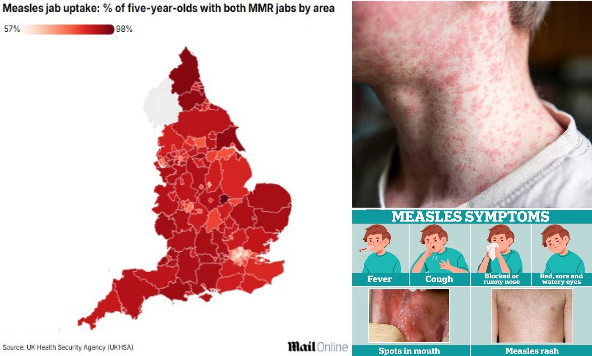Half of Children Unvaccinated in Shocking UK Region as Measles Cases Rise