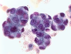 Organ Chips Precisely Predict Chemo Response for Esophageal Adenocarcinoma Patients
