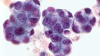Organ Chips Precisely Predict Chemo Response for Esophageal Adenocarcinoma Patients
