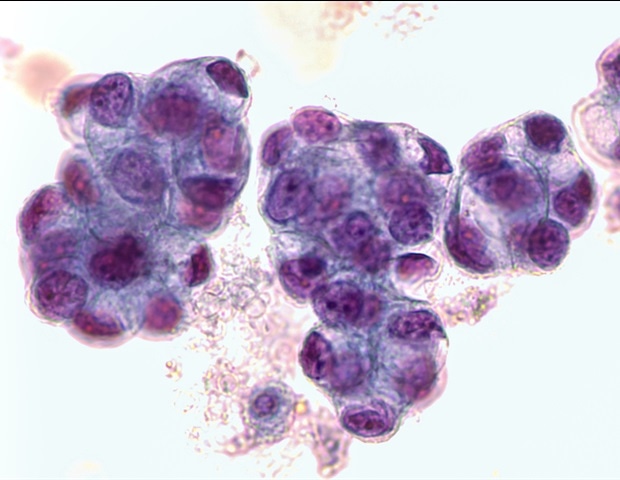 Organ Chips Precisely Predict Chemo Response for Esophageal Adenocarcinoma Patients
