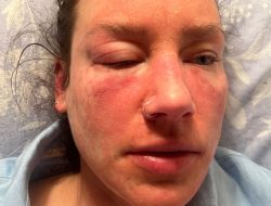 My Skin Turned Into Flames: Common Cream Caused Burns-Like Reaction, Could Last Years