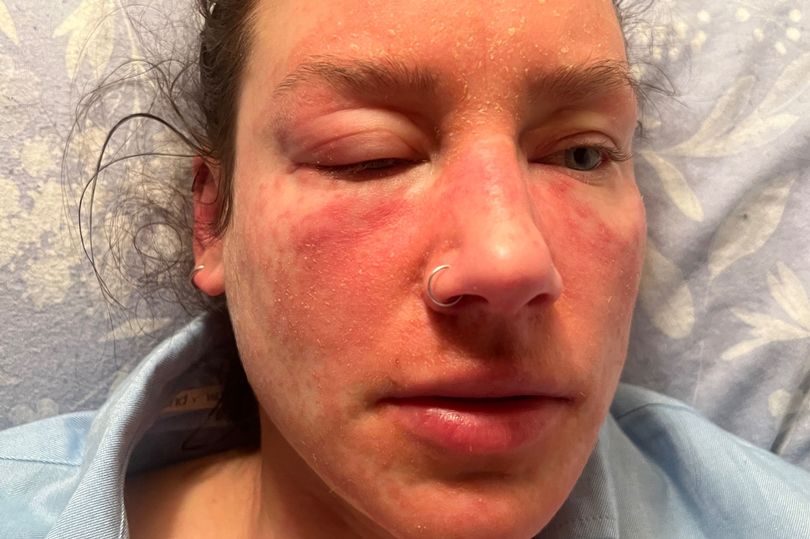 My Skin Turned Into Flames: Common Cream Caused Burns-Like Reaction, Could Last Years