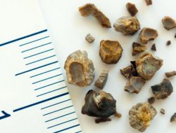 Gejala dan Risiko Batu Ginjal: Waspadai Sebelum Terlambat
