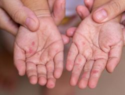 Wabah Campak di Medan: Kenali Penyebab dan Gejalanya Wabah Campak di Medan: Kenali Penyebab dan Gejalanya