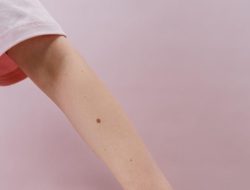 4 Penyebab Tahi Lalat Mendadak Muncul – Apakah Perlu Dikhawatirkan? 4 Penyebab Tahi Lalat Mendadak Muncul – Apakah Perlu Dikhawatirkan?