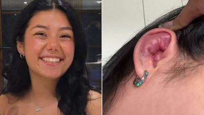 Woman Mistakes Mosquito Bite for Ear Swelling — Until It Oozed ‘Poison’