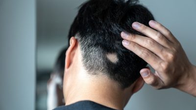 Could Serotonin Supplements Be the New Hair Loss Solution?