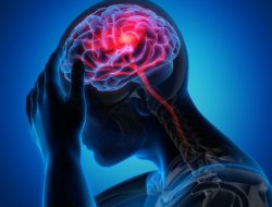 Cara Mengatasi Serangan Stroke untuk Hindari Kecacatan Permanen