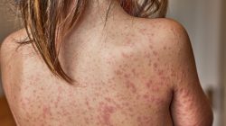 Child Dies of Measles in Liverpool as Virus Sparks Wildfire Warning