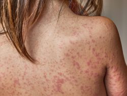 Child Dies of Measles in Liverpool as Virus Sparks Wildfire Warning