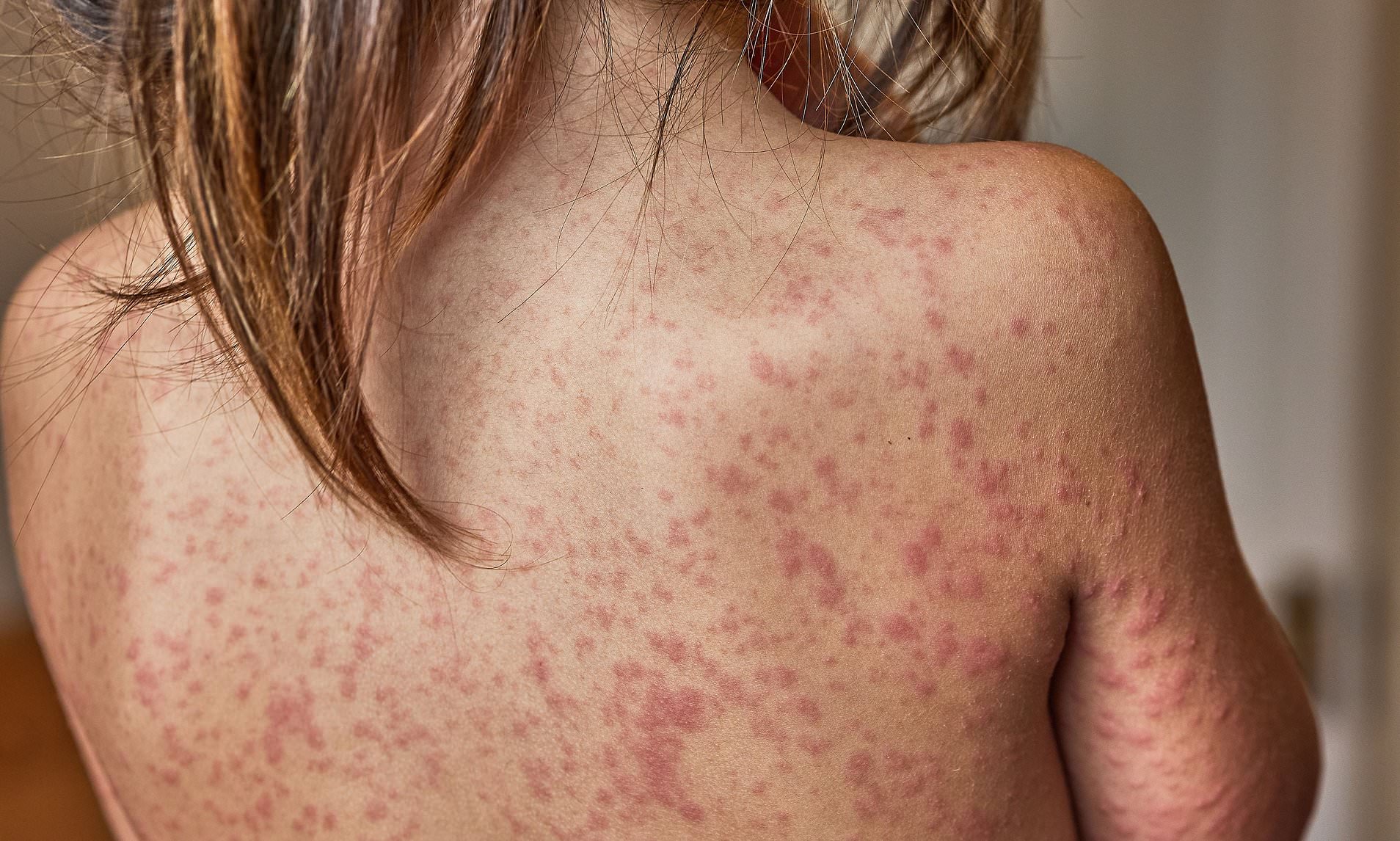Child Dies of Measles in Liverpool as Virus Sparks Wildfire Warning
