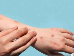 Kenali Penyebab dan Risiko Cacar Api pada Lansia dan Wanita