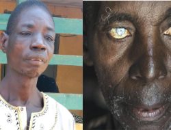 Why 43 million Nigerians face river blindness – Experts
