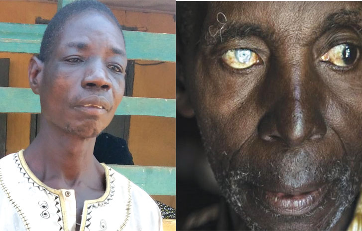 Why 43 million Nigerians face river blindness – Experts