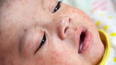 Wabah Campak Tewaskan 12 Anak, Imunisasi Rendah Jadi Sorotan
