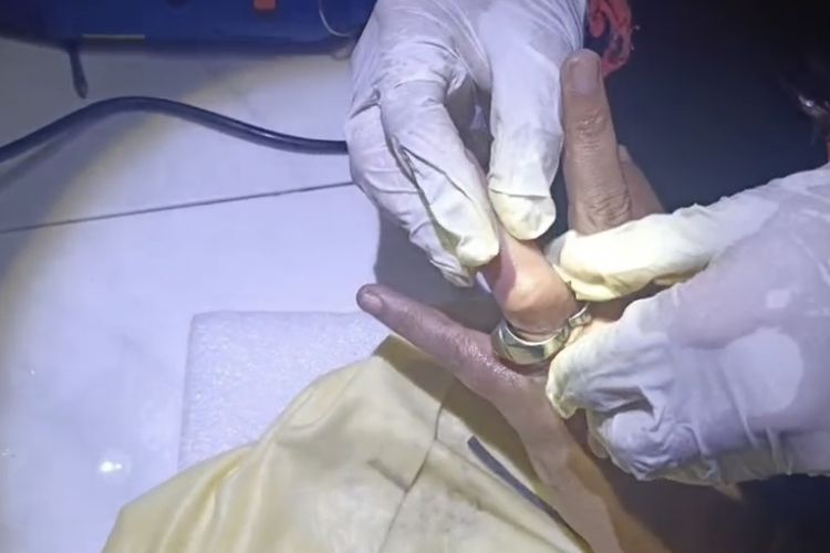 Jari Bengkak Akibat Gigitan Serangga, Petugas Pemadam Bantu Lepaskan Cincin