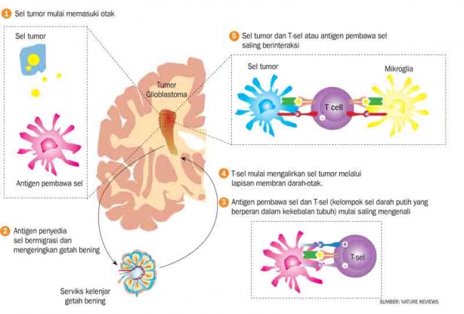 Sejarah Penyakit Bintang The Walking Dead: Jenis Glioma