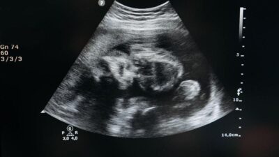 Kapan Jenis Kelamin Bayi Diketahui?