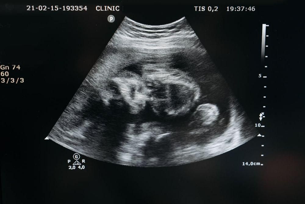 Kapan Jenis Kelamin Bayi Diketahui?