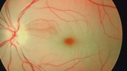 Fakta Penting tentang Oklusi Arteri Retina atau “Stroke Mata”
