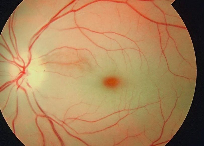 Fakta Penting tentang Oklusi Arteri Retina atau “Stroke Mata”